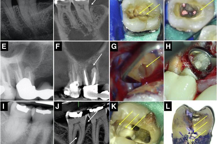 CBCT Patterns of Bone Loss and Clinical Predictors for the Diagnosis of
